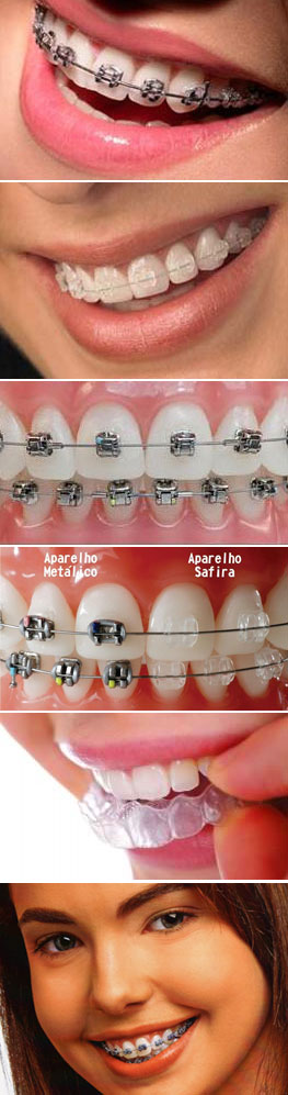 Ortodontia pode resolver DTM? - Dentista em Foz do Iguaçu - Aparelho  Ortodôntico - Facetas - Implantes - Próteses - Prime Sorriso Odontologia